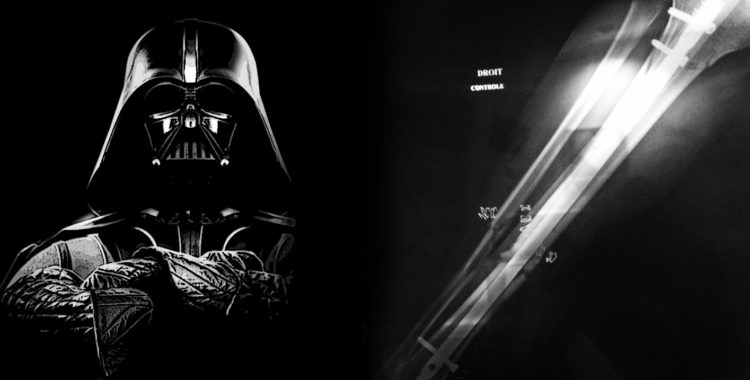 En fransk röntgenplåt föreställande ett klent svenskt ben.