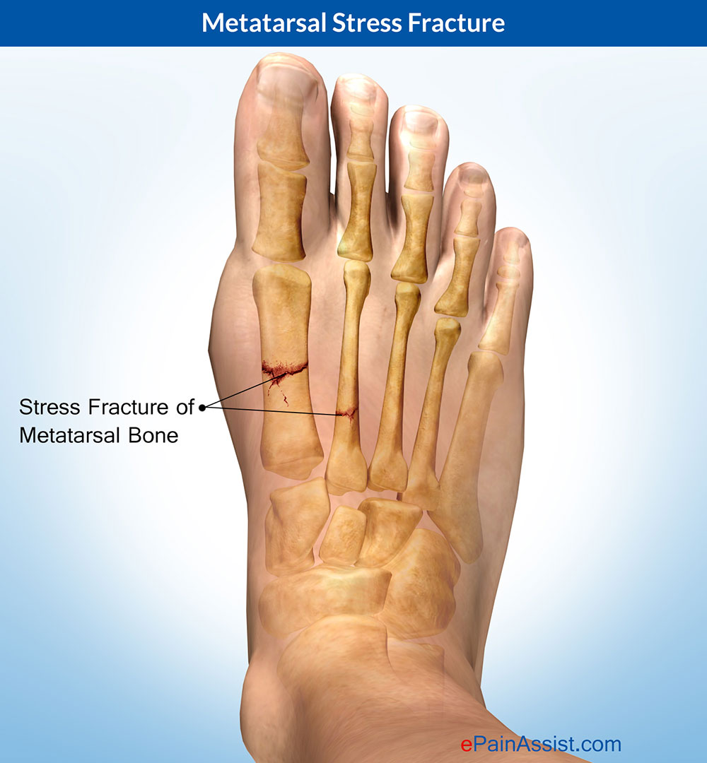 Metatarsal-Stress-Fracture.jpg
