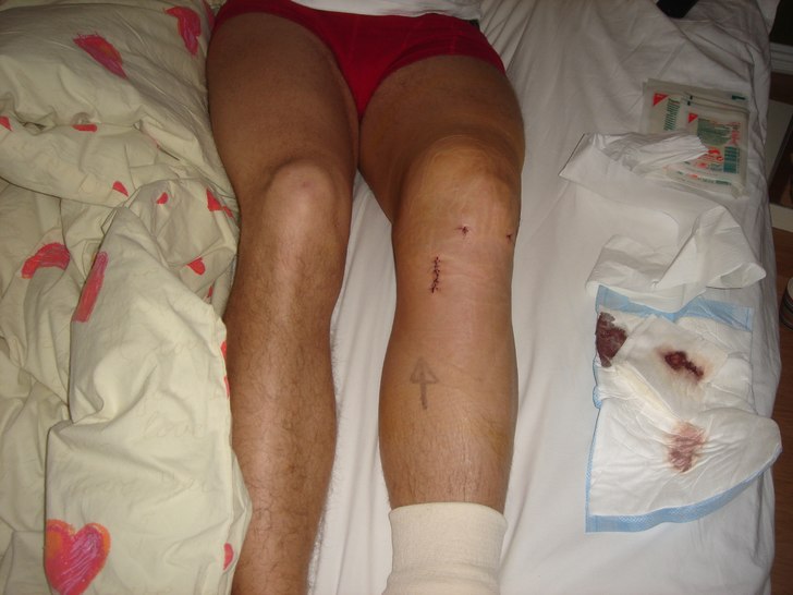 Ja vad säger man. Efter en smärtsam knäoperatio. Foto: Anna Hauge. Åkare: Johan "Fles" Gustafson.