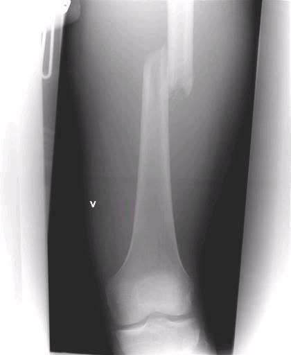 Lårbens brudd. Foto: Sentralsykehuset i førde. Åkare: Erlend Reime.