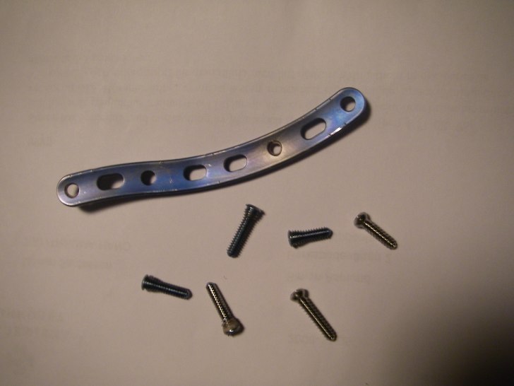 titanet som satt i min axel^. Foto: sez.