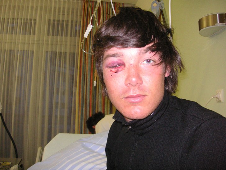 brutet okben och lite av näsan,
men allt klär e. Foto: mamma. Åkare: johan persson.