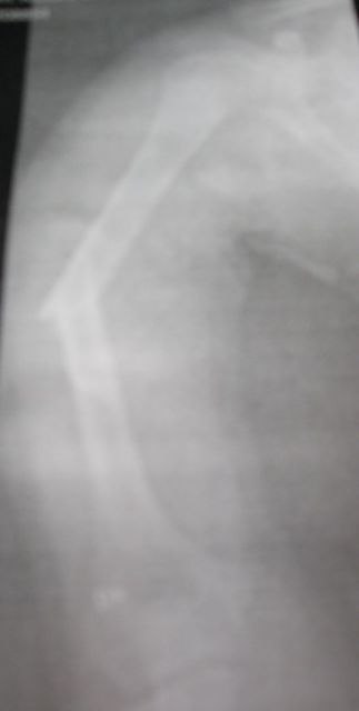 Bryten överarm.
17januari = seasonender.. Foto: Sjukhus. Åkare: Jesper Engström.