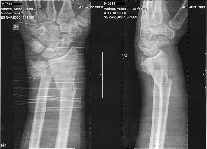 2 april. Foto: läkarn. Åkare: jag.