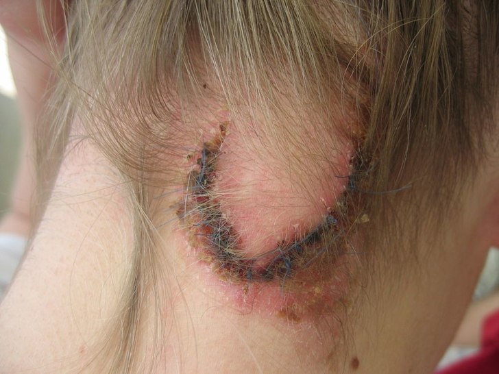 ett litet lätt sår efter en liten lätt vurpa.... Foto: derik. Åkare: vitor karlssen.