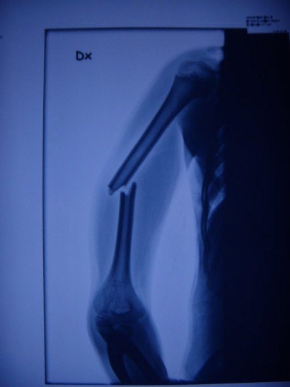 Min brors arm efter han hade testat sideflip i med. Åkare: Johan.