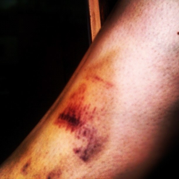 Fick fina färger på benet en dag. Foto: Karin Bergstedt.