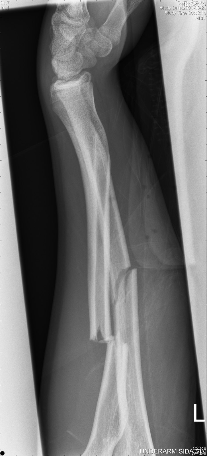avbruten arm. Foto: dom på röntgen. Åkare: jontex.
