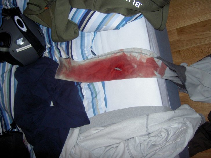 Skar mig lite på stålkanten..... 9 stygn... Foto: Filip Alexandersson. Åkare: Filip Alexandersson.