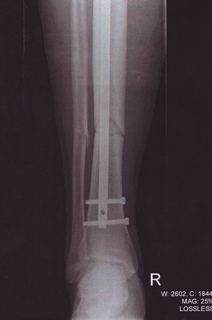 En fantastisk dag i offpisten med 20 -25 cm snö s. Foto: Ringerike Sykehus. Åkare: Christian.