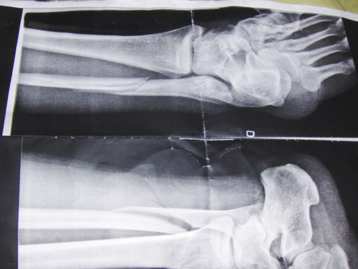Anledningen till att jag inte blev en bätre skate. Foto: röntgenläkare nus. Åkare: Anders mangs.