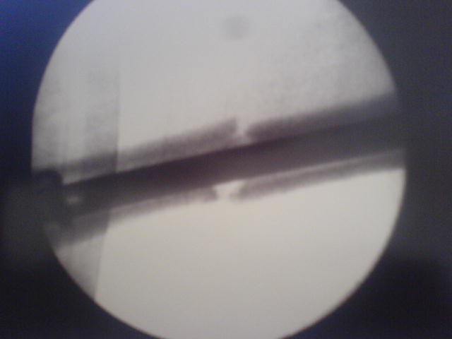 Min arm :/ det svarta i mitten är en spik :P. Foto: Läkaren. Åkare: Jag.