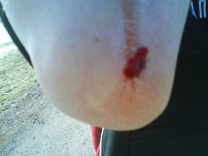 Fick ett litet sår när jag skulle åke ner från. Foto: Simon Johansson. Åkare: Simon Johansson.