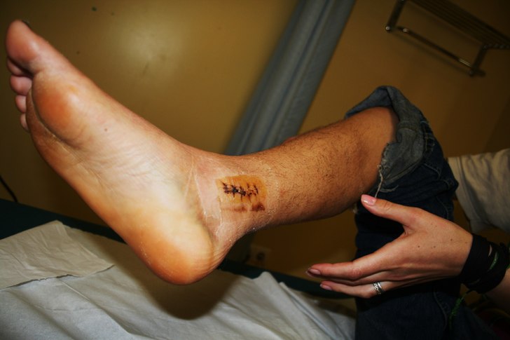 Mitt anorexia ben efter 6 veckor i gips, nice hål. Foto: julius aspman. Åkare: Hilla.