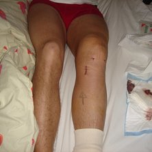 Ja vad s&auml;ger man. Efter en sm&auml;rtsam kn&auml;operatio. Foto: Anna Hauge. &Aring;kare: Johan &amp;quot;Fles&amp;quot; Gustafson.