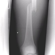 L&aring;rbens brudd. Foto: Sentralsykehuset i f&oslash;rde. &Aring;kare: Erlend Reime.