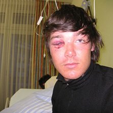 brutet okben och lite av n&auml;san,
men allt kl&auml;r e. Foto: mamma. &Aring;kare: johan persson.