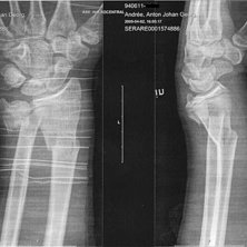 2 april. Foto: l&auml;karn. &Aring;kare: jag.