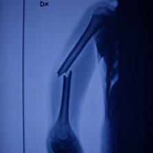 Min brors arm efter han hade testat sideflip i med. &Aring;kare: Johan.