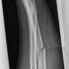 avbruten arm. Foto: dom p&aring; r&ouml;ntgen. &Aring;kare: jontex.