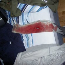 Skar mig lite p&aring; st&aring;lkanten..... 9 stygn... Foto: Filip Alexandersson. &Aring;kare: Filip Alexandersson.