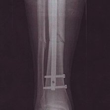 En fantastisk dag i offpisten med 20 -25 cm sn&ouml; s. Foto: Ringerike Sykehus. &Aring;kare: Christian.
