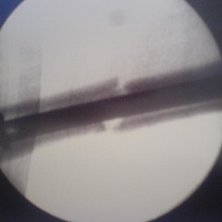 Min arm :/ det svarta i mitten &auml;r en spik :P. Foto: L&auml;karen. &Aring;kare: Jag.