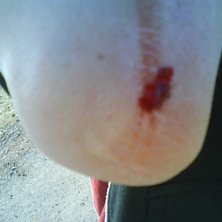 Fick ett litet s&aring;r n&auml;r jag skulle &aring;ke ner fr&aring;n. Foto: Simon Johansson. &Aring;kare: Simon Johansson.