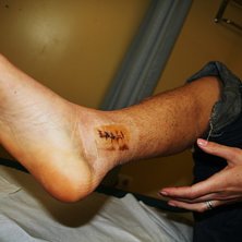 Mitt anorexia ben efter 6 veckor i gips, nice h&aring;l. Foto: julius aspman. &Aring;kare: Hilla.